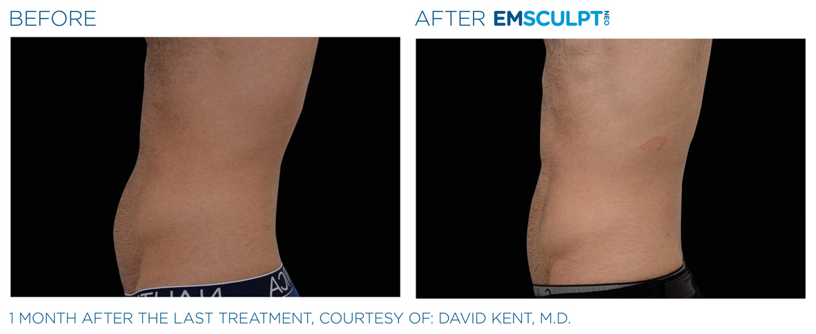 EMSCULPT NEO Before & After | Dr. Doug Willen | EMSCULPT NEO & EMSELLA