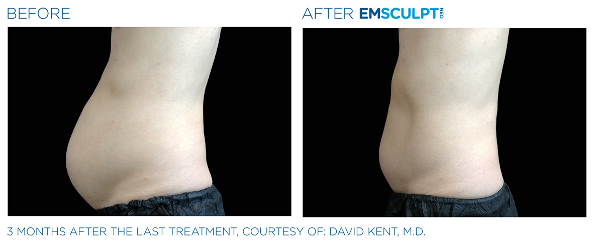 EMSCULPT NEO Before & After | Dr. Doug Willen | EMSCULPT NEO & EMSELLA